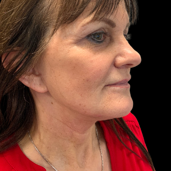 after-deep-plane-facelift-necklift